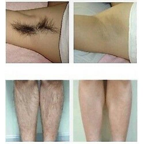 UNDERARM PERMANENT LASER HAIR REMOVAL