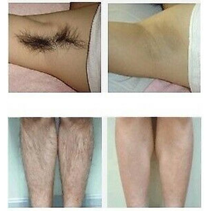 UNDERARM PERMANENT LASER HAIR REMOVAL