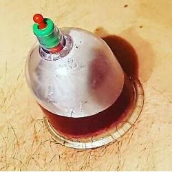 1 day hijama cupping diploma course beauty clinic certificate wet dry hot massage uk mobile training