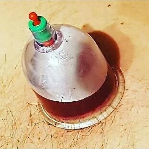 1 day hijama cupping diploma course beauty clinic certificate wet dry hot massage uk mobile training